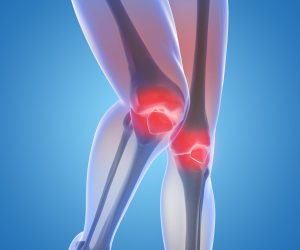 Артроз коленного сустава: симптомы, причины и методы лечения