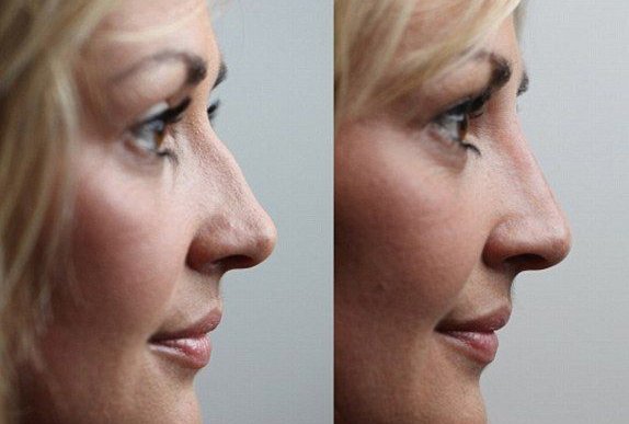 Коррекция горбинки носа