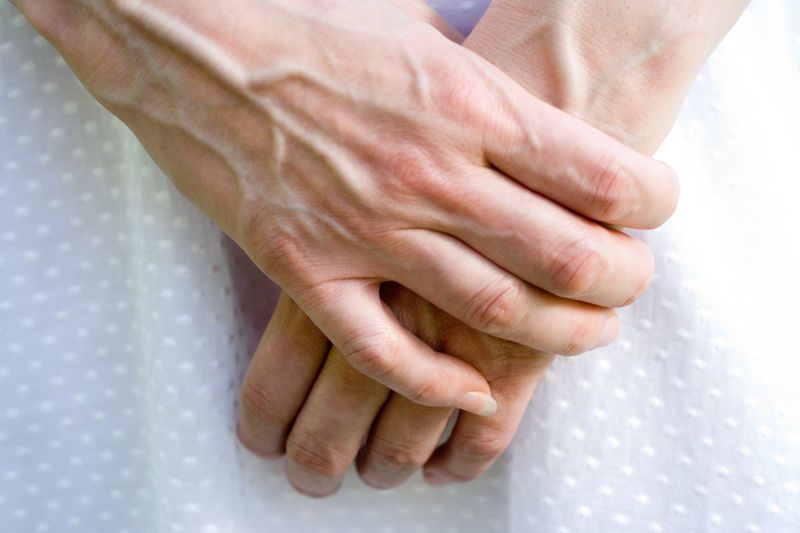 Причины варикоза рук